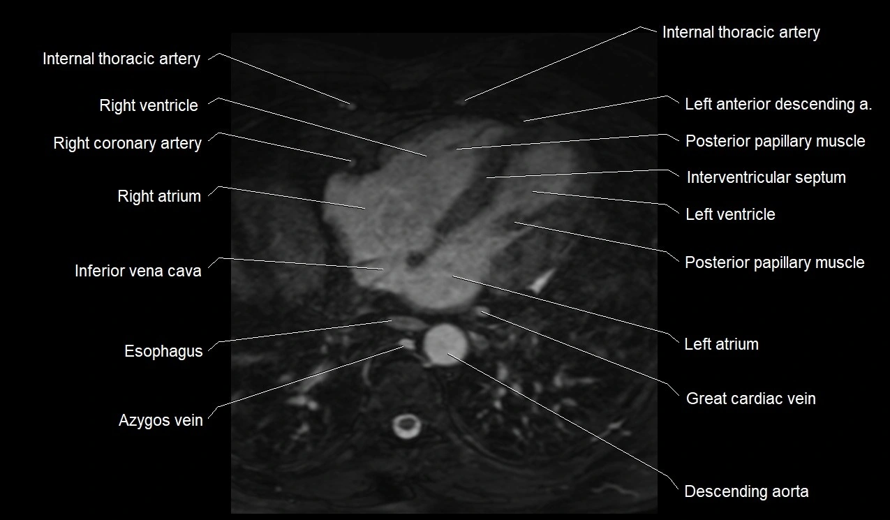 MRI heart coronary arteries and coronary veins anatomy axial image 32.webp